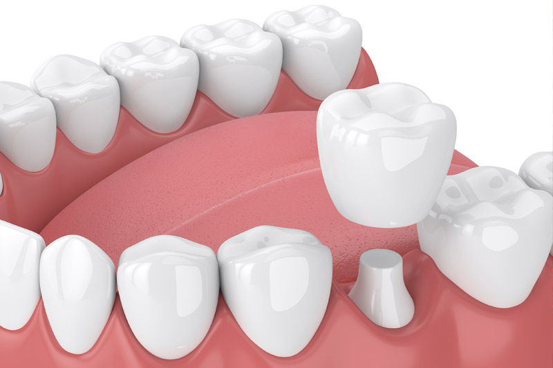 Dental Crowns in Garland