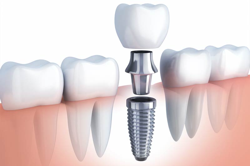 Implants Dentist in Garland