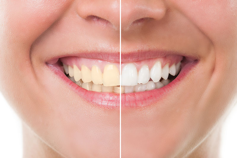 Teeth Whitening in Garland