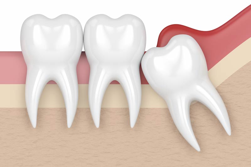 Wisdom Tooth Removal in Garland